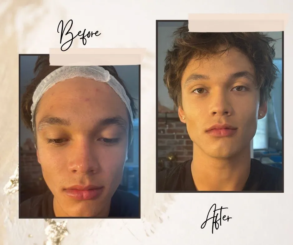 Before-and-after composition showing a person wearing a hair covering and looking down in the Before photo and looking forward with short hair in the After photo.
